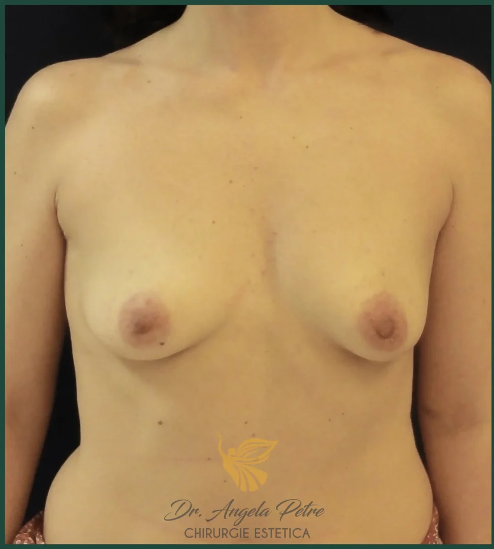 Caz 02 Mărire sâni cu implanturi de silicon, frontal, before, Dr. Angela Petre - București