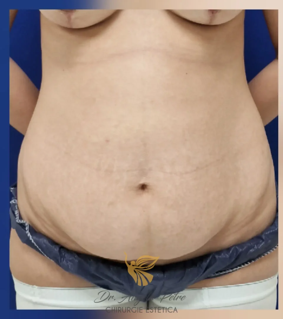 Caz 10 Abdominoplastie, frontal, before, Dr. Angela Petre - București