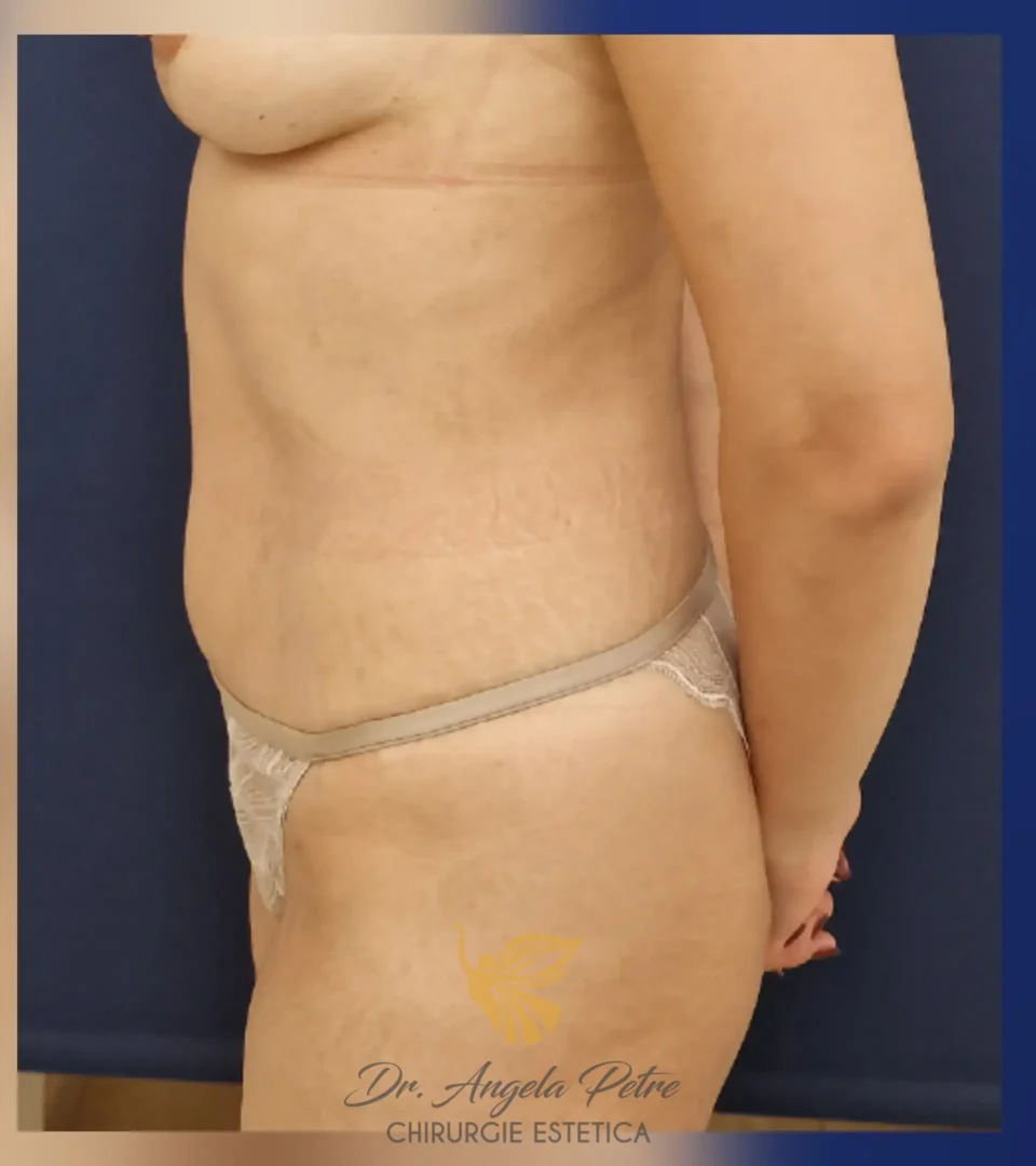 Caz 10 Abdominoplastie, profil, after, Dr. Angela Petre - București