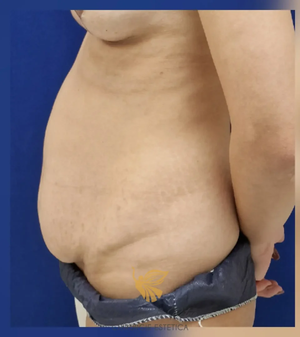 Caz 10 Abdominoplastie, profil, before, Dr. Angela Petre - București