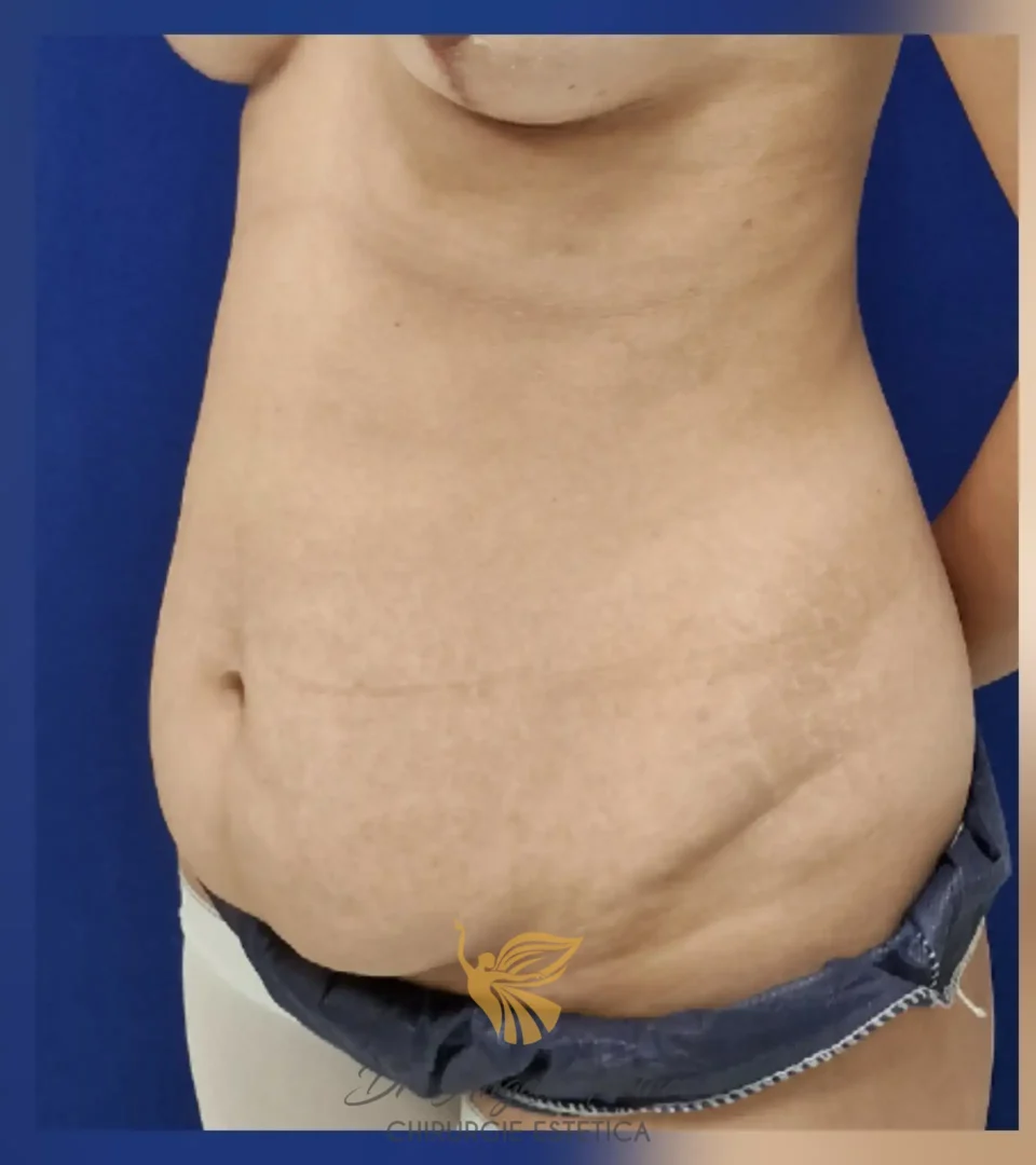 Caz 10 Abdominoplastie, semiprofil, before, Dr. Angela Petre - București