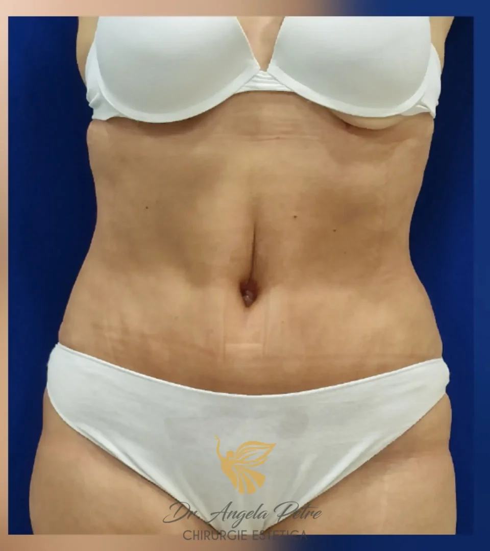 Caz 11 Abdominoplastie, frontal, after, Dr. Angela Petre - București