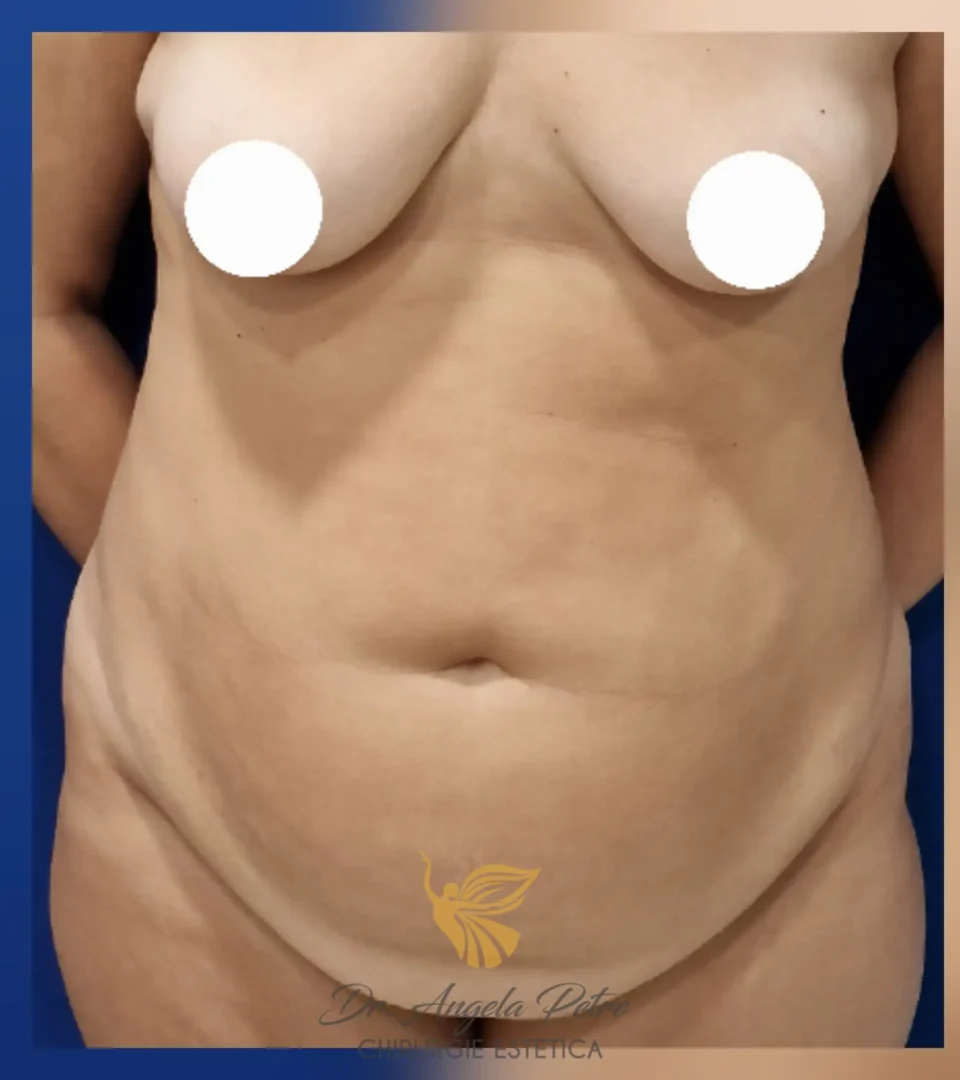 Caz 11 Abdominoplastie, frontal, before, Dr. Angela Petre - București