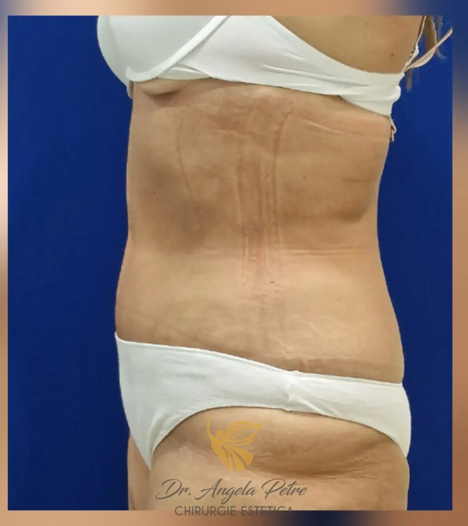Caz 11 Abdominoplastie, profil, after, Dr. Angela Petre - București