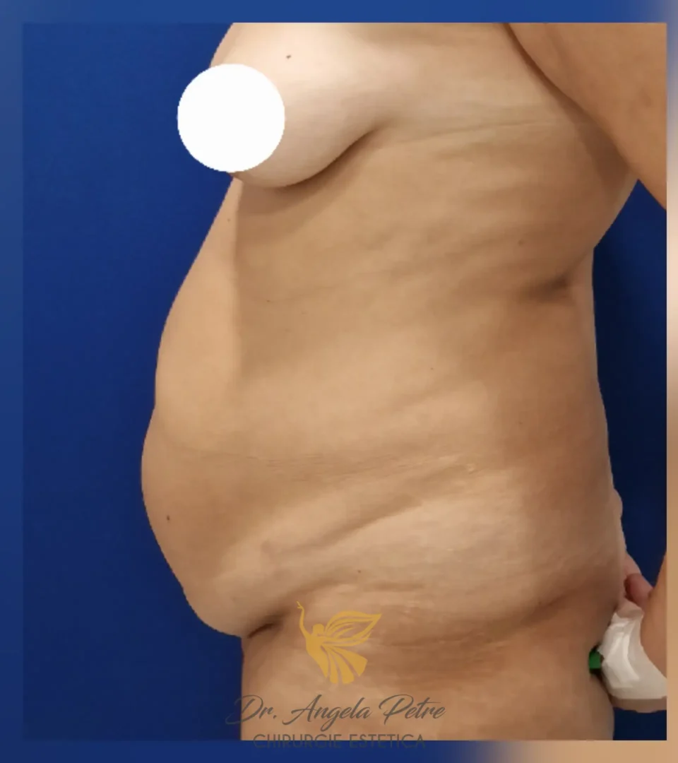 Caz 11 Abdominoplastie, profil, before, Dr. Angela Petre - București