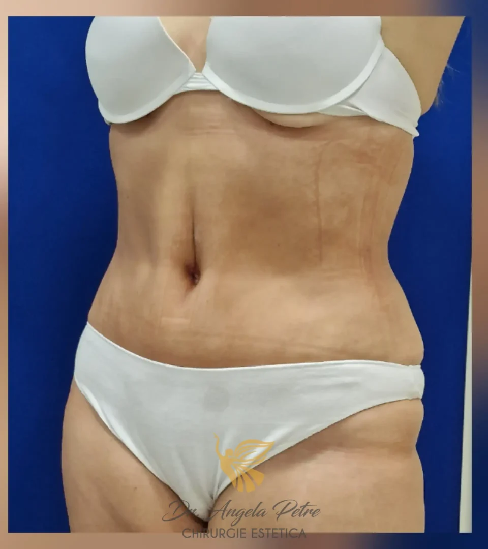 Caz 11 Abdominoplastie, semiprofil, after, Dr. Angela Petre - București