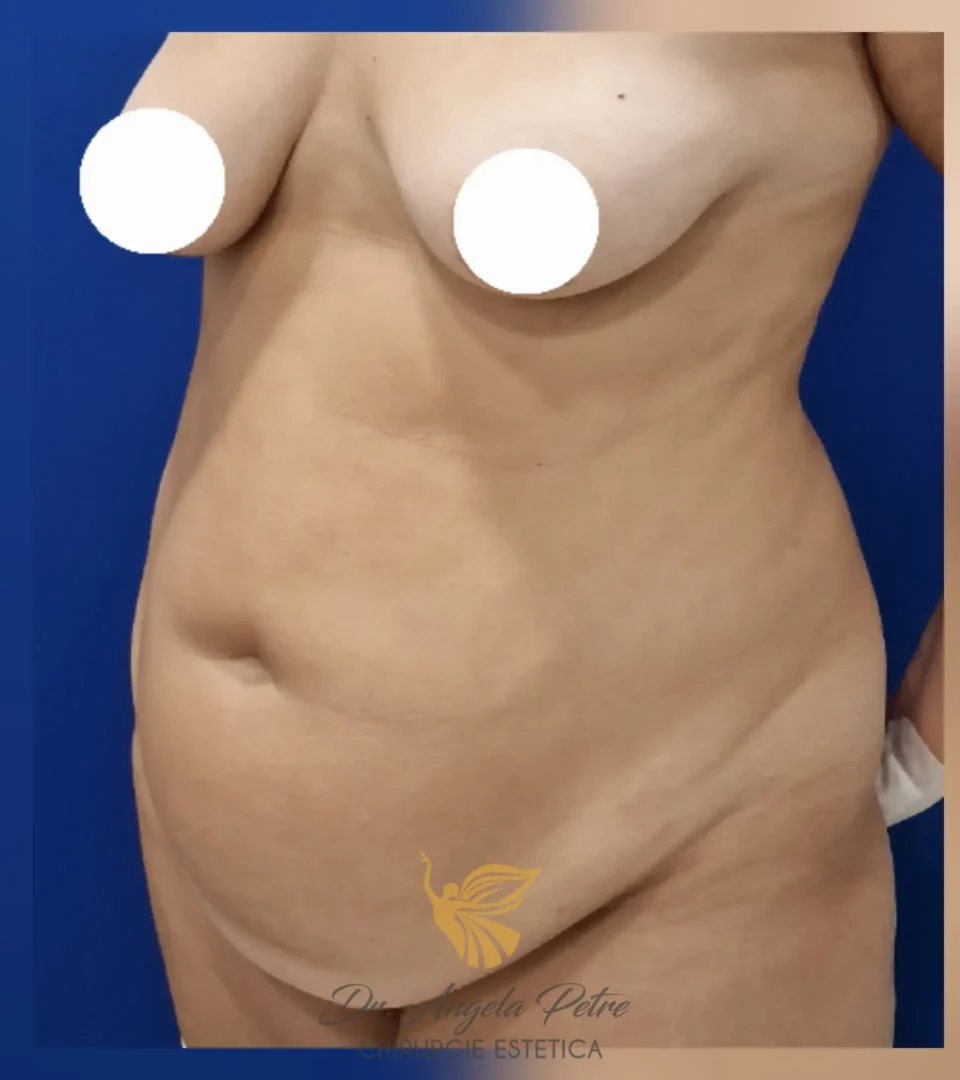 Caz 11 Abdominoplastie, semiprofil, before, Dr. Angela Petre - București