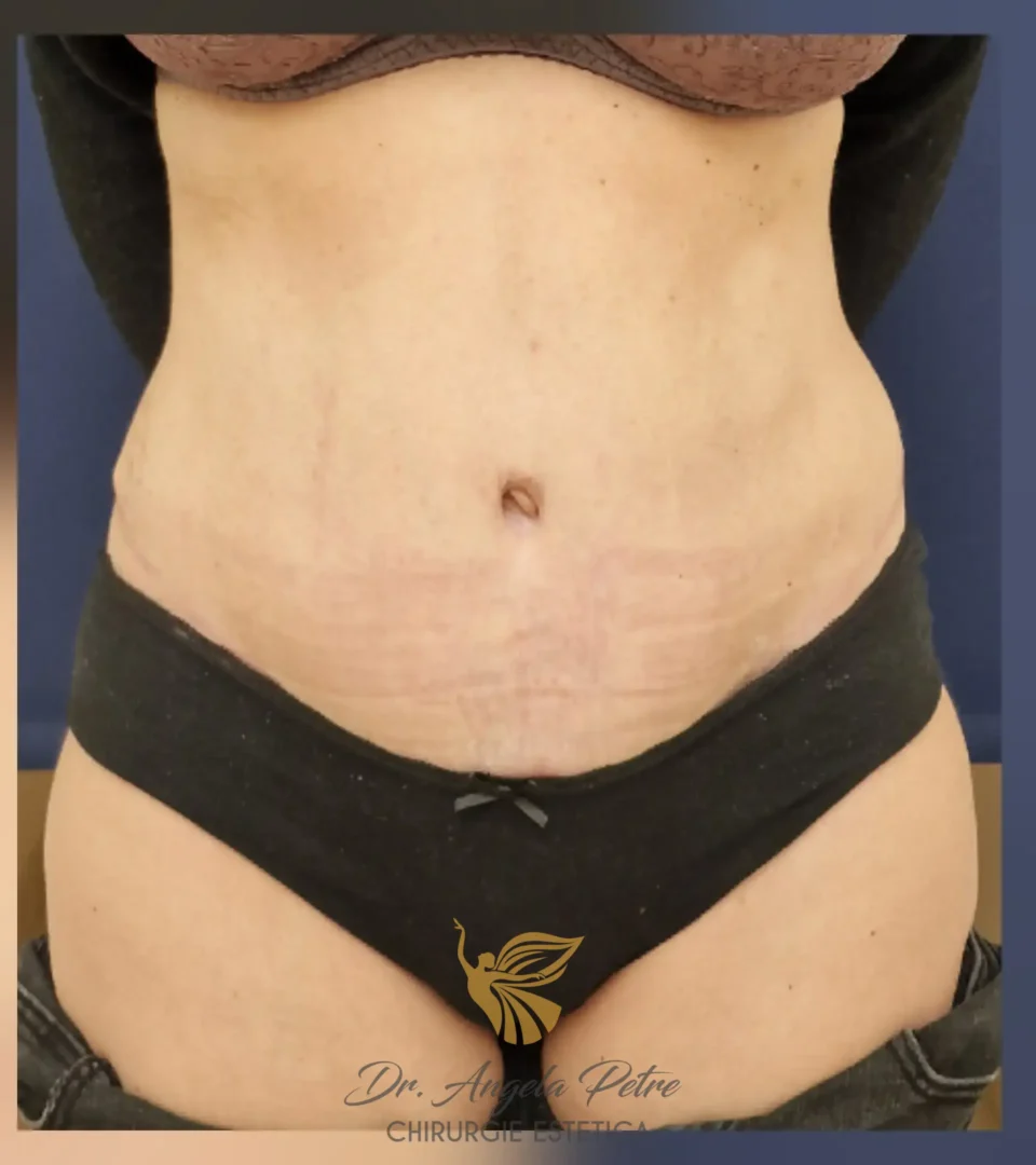 Caz 12 Abdominoplastie, frontal, after, Dr. Angela Petre - București