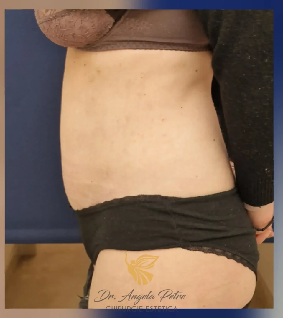 Caz 12 Abdominoplastie, profil, after, Dr. Angela Petre - București