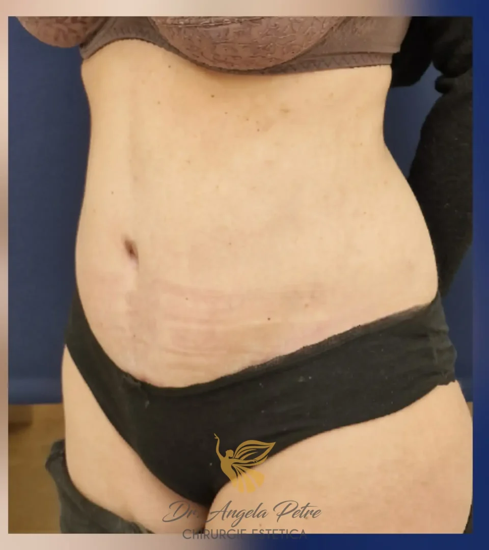 Caz 12 Abdominoplastie, semiprofil, after, Dr. Angela Petre - București