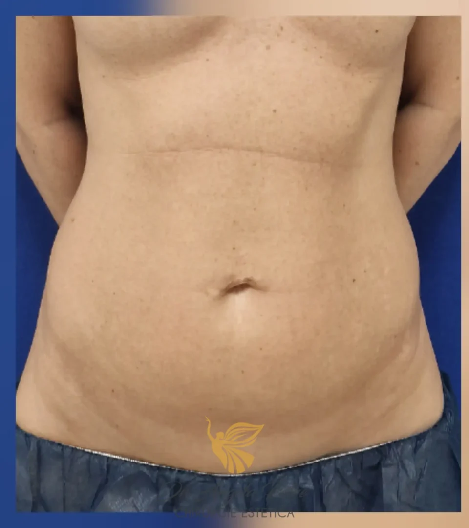 Caz 13 Abdominoplastie, frontal, before, Dr. Angela Petre - București