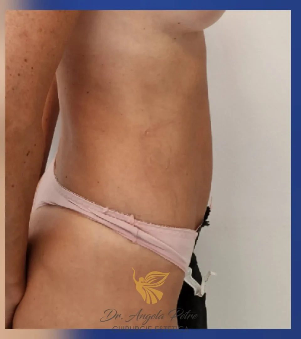 Caz 13 Abdominoplastie, profil, after, Dr. Angela Petre - București