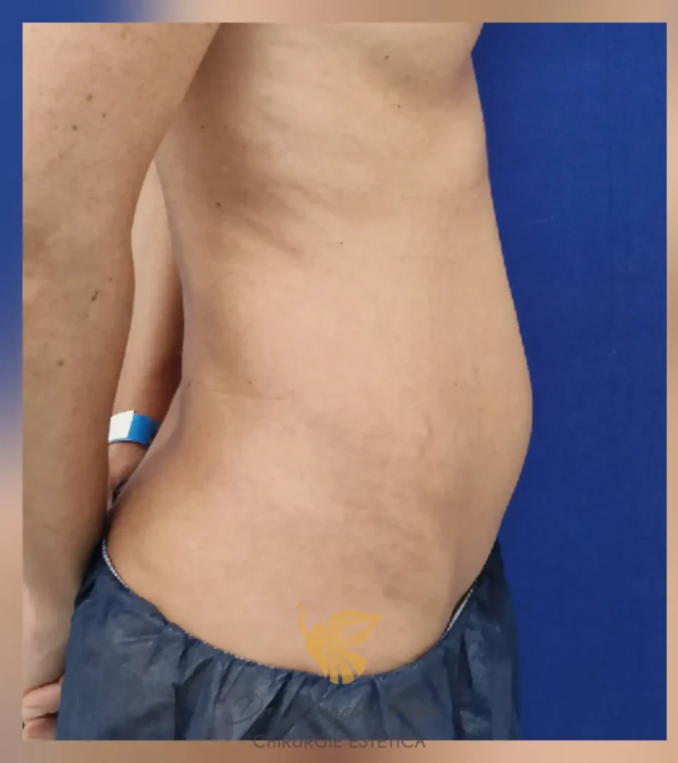 Caz 13 Abdominoplastie, profil, before, Dr. Angela Petre - București