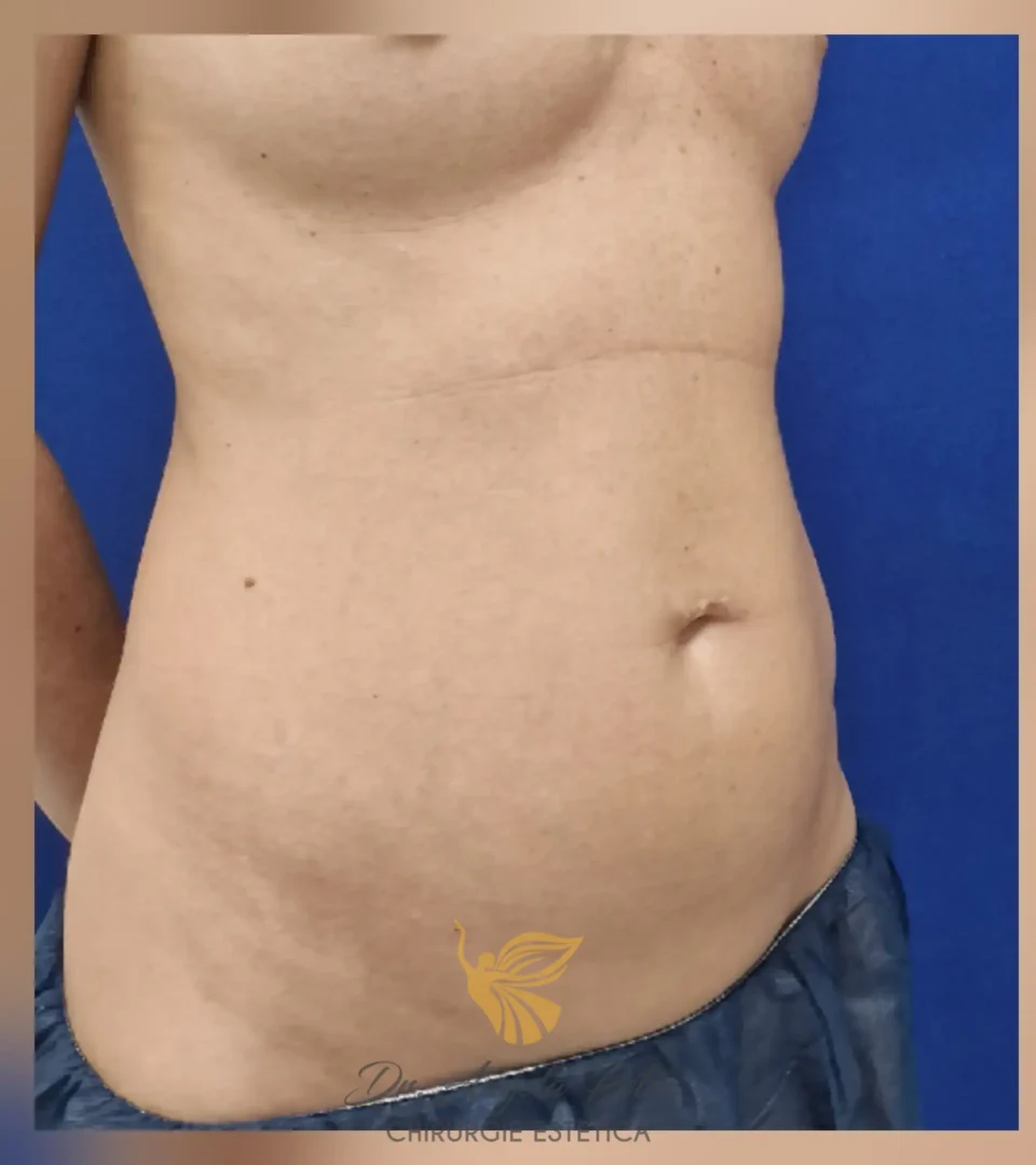 Caz 13 Abdominoplastie, semiprofil, before, Dr. Angela Petre - București