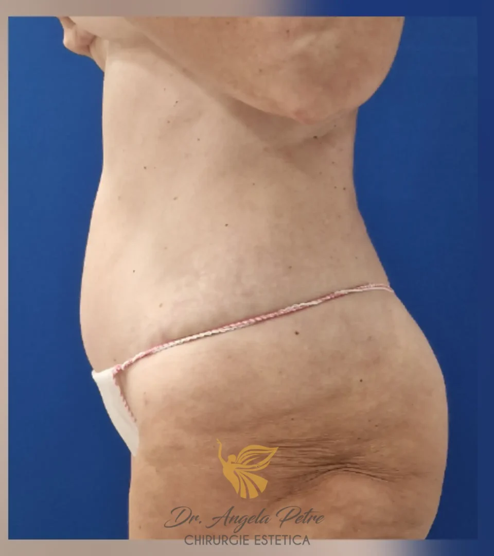 Caz 14 Abdominoplastie, profil, after, Dr. Angela Petre - București