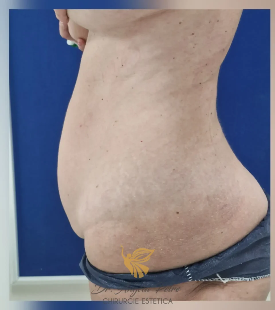 Caz 14 Abdominoplastie, profil, before, Dr. Angela Petre - București