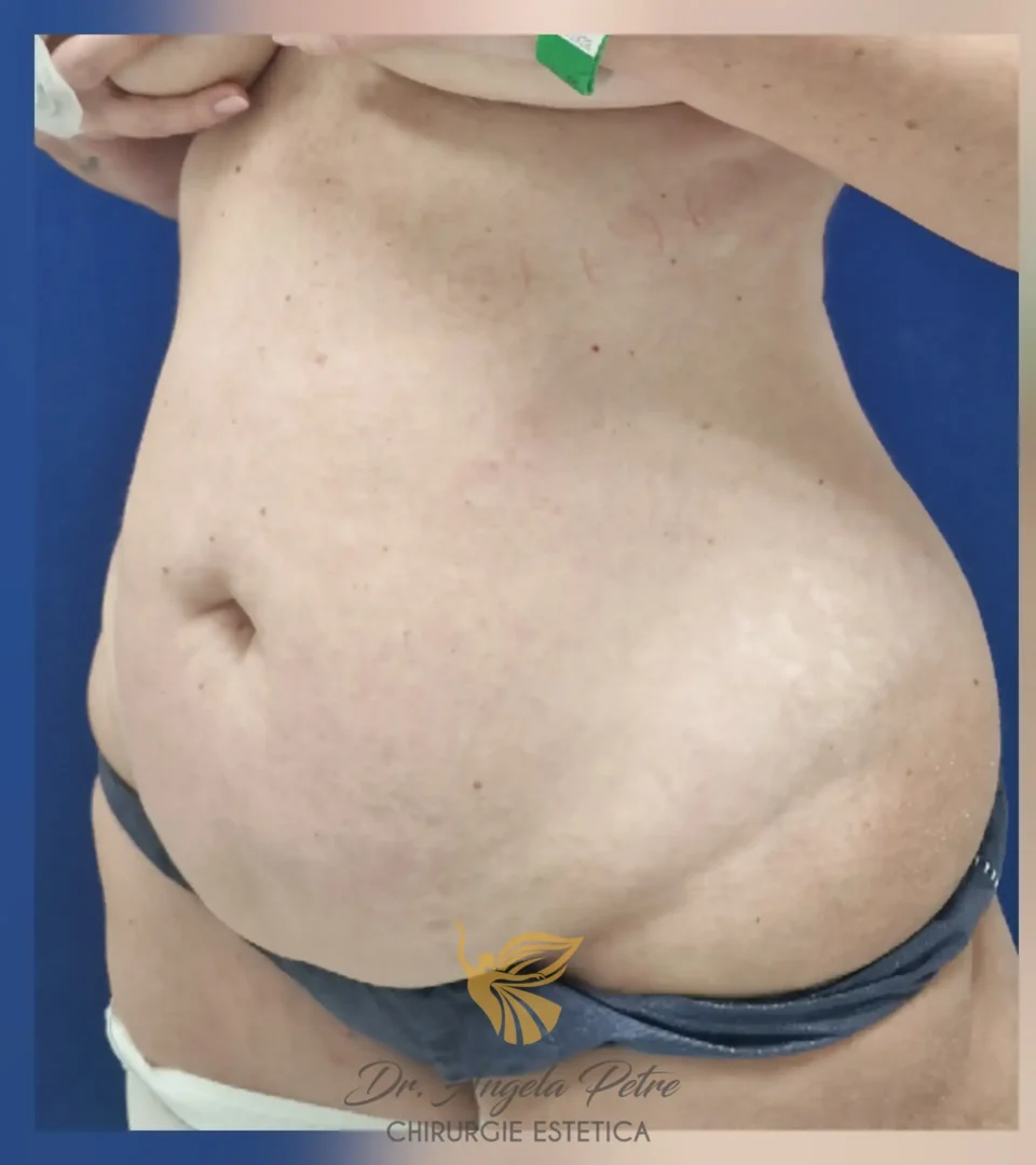 Caz 14 Abdominoplastie, semiprofil, before, Dr. Angela Petre - București