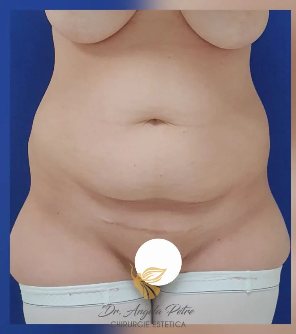Caz 15 Abdominoplastie, frontal, before, Dr. Angela Petre - București