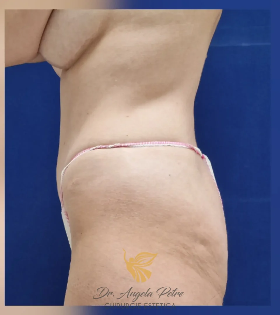 Caz 15 Abdominoplastie, profil, after, Dr. Angela Petre - București