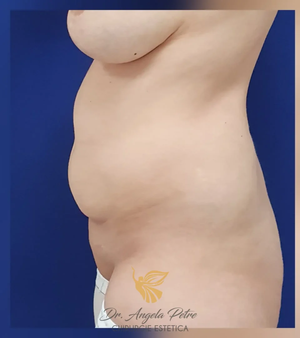 Caz 15 Abdominoplastie, profil, before, Dr. Angela Petre - București