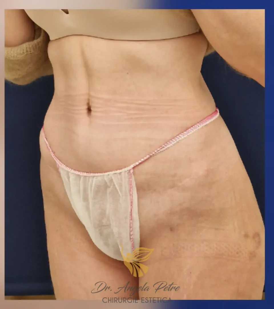 Caz 15 Abdominoplastie, semiprofil, after, Dr. Angela Petre - București