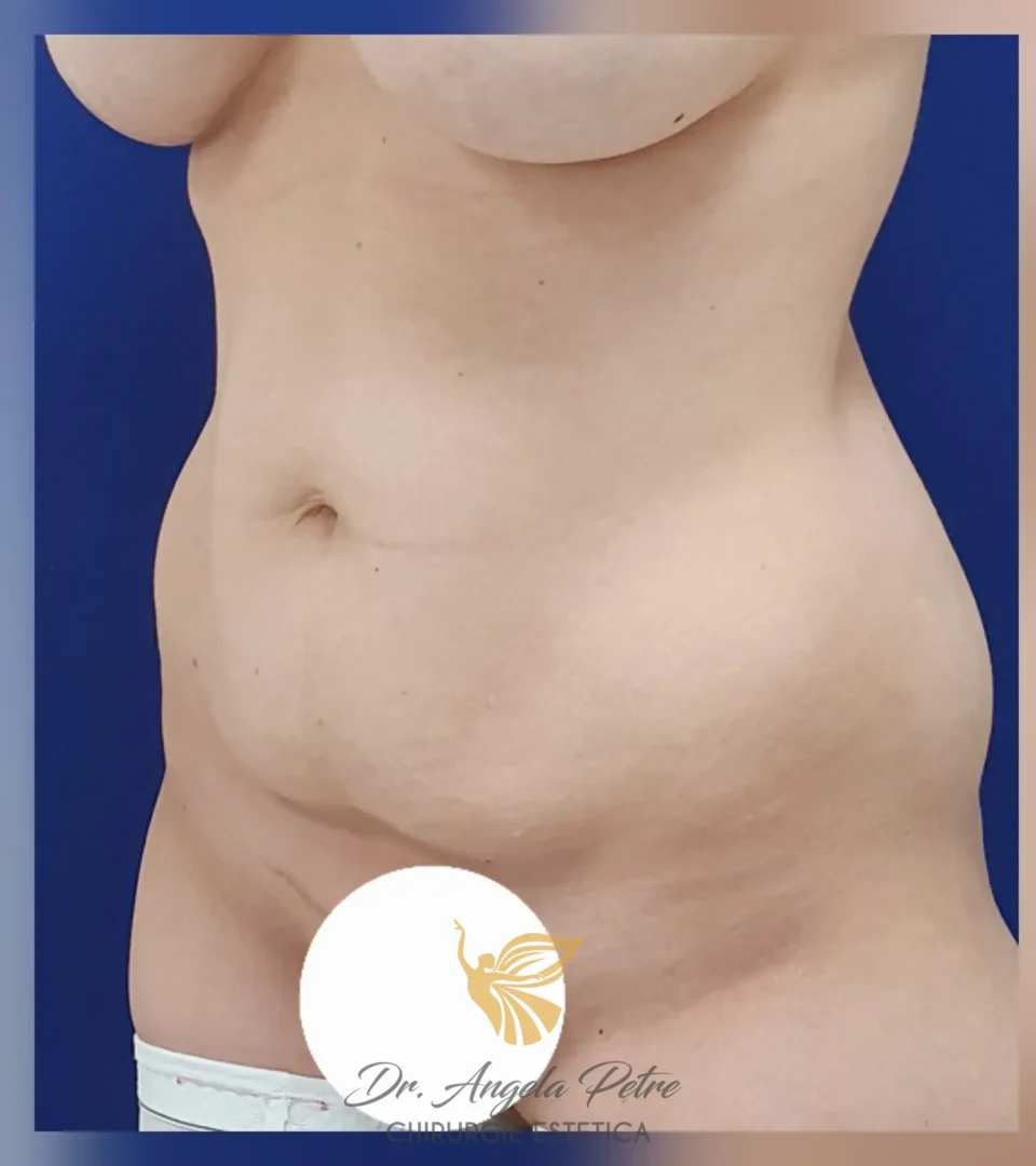 Caz 15 Abdominoplastie, semiprofil, before, Dr. Angela Petre - București