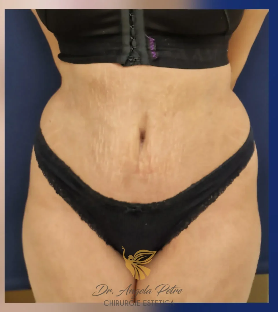 Caz 16 Abdominoplastie, frontal, after, Dr. Angela Petre - București