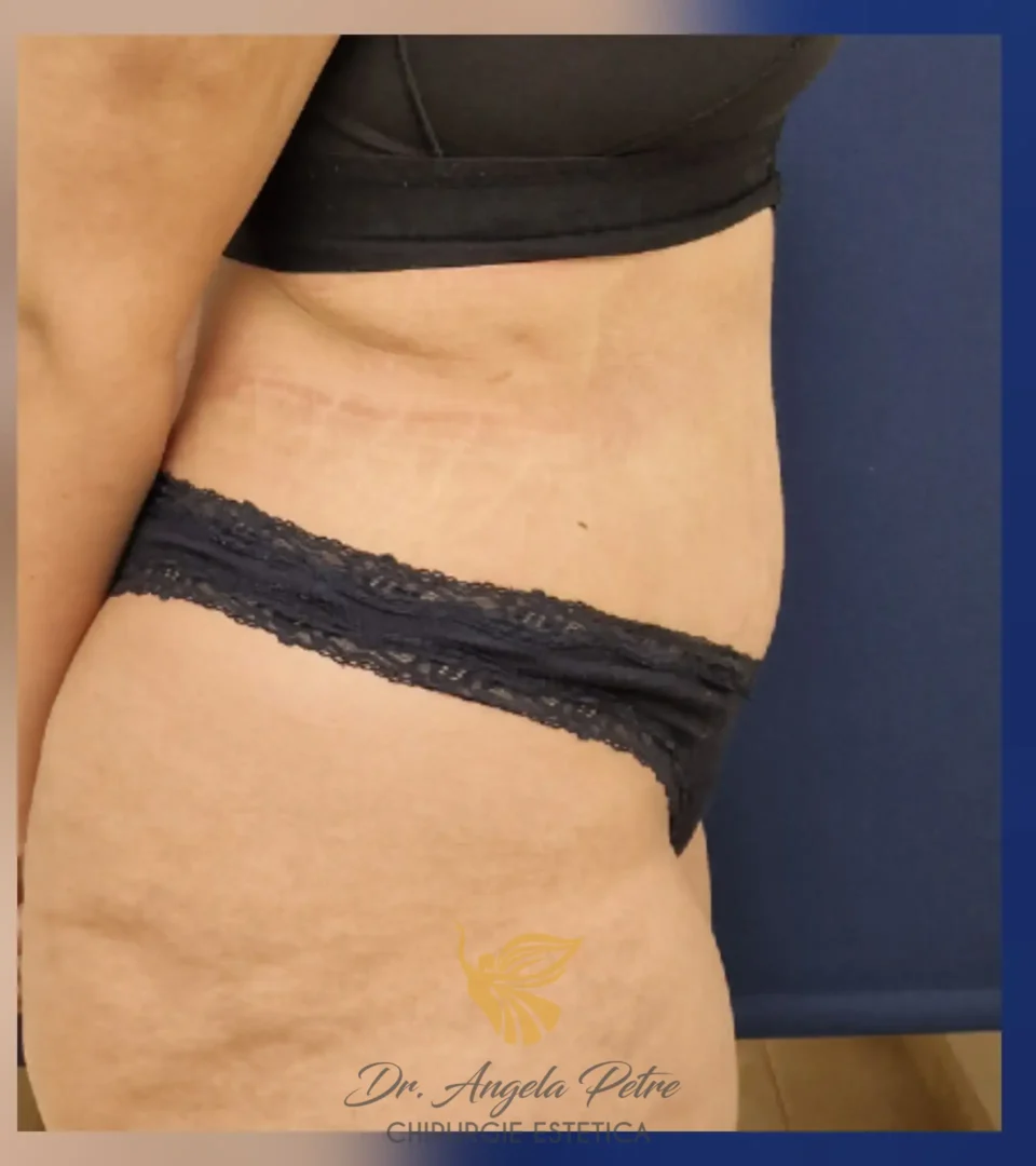 Caz 16 Abdominoplastie, profil, after, Dr. Angela Petre - București