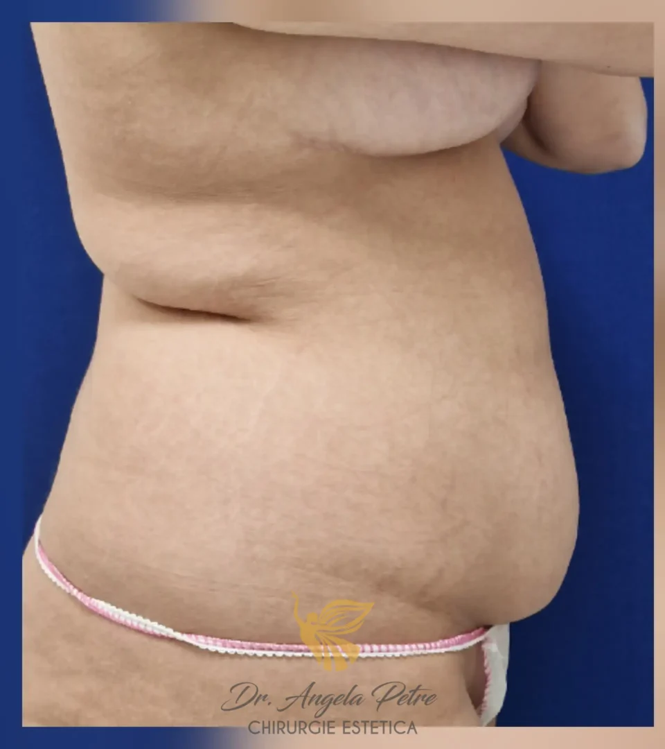 Caz 16 Abdominoplastie, profil, before, Dr. Angela Petre - București