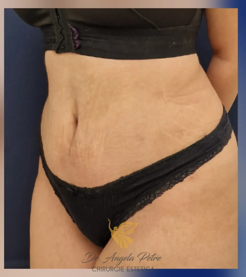 Caz 16 Abdominoplastie, semiprofil, after, Dr. Angela Petre - București