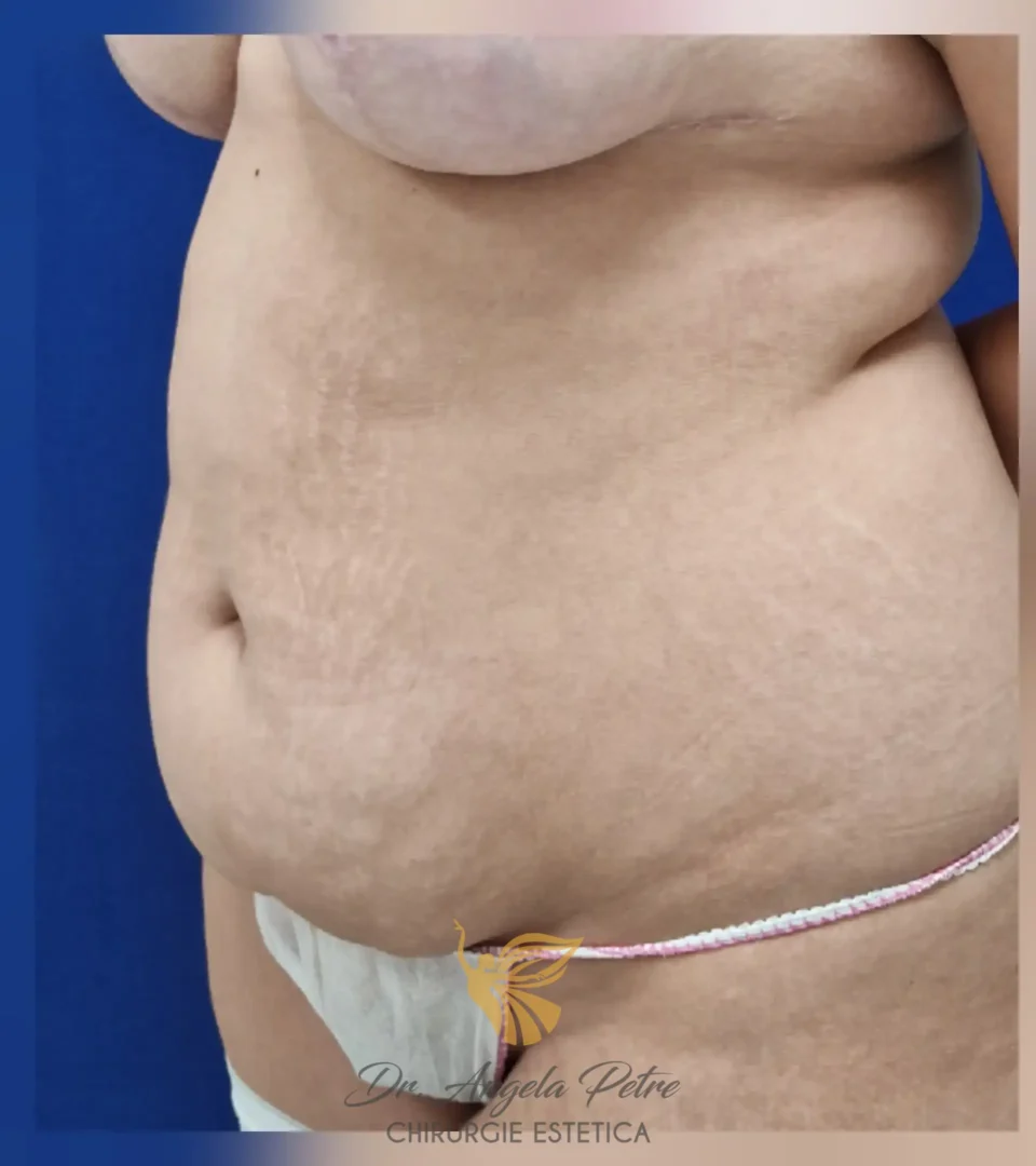 Caz 16 Abdominoplastie, semiprofil, before, Dr. Angela Petre - București