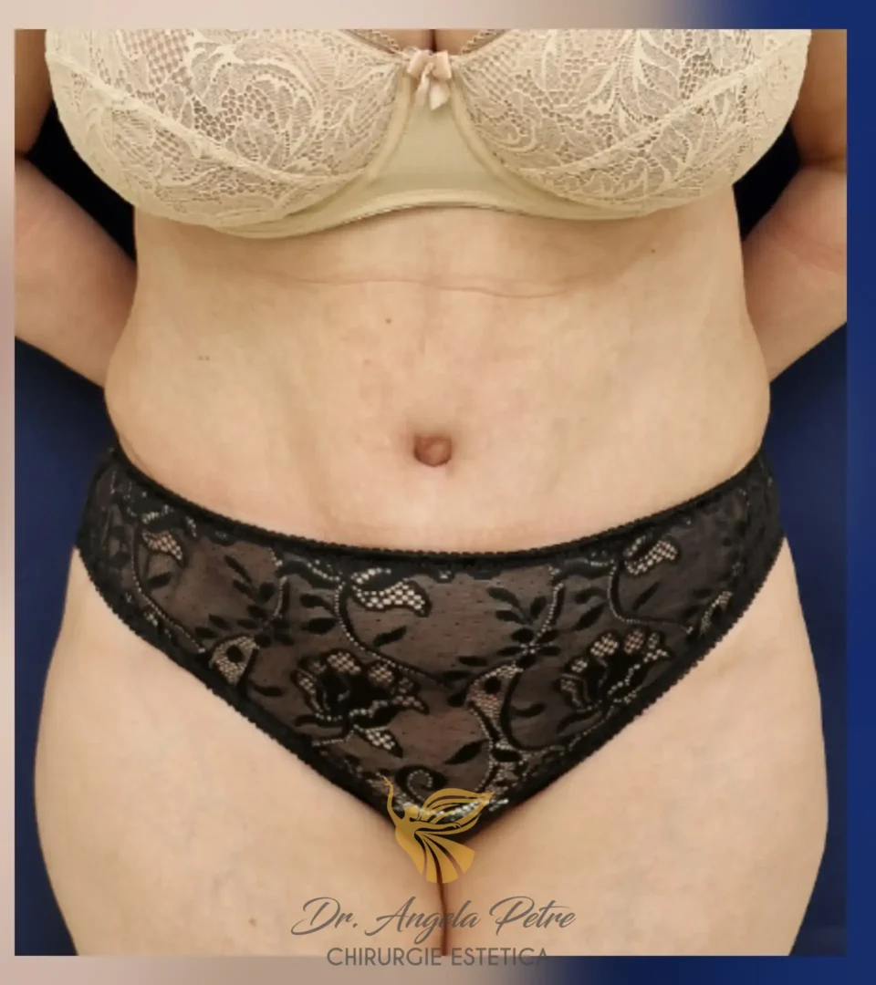Caz 17 Abdominoplastie, frontal, after, Dr. Angela Petre - București