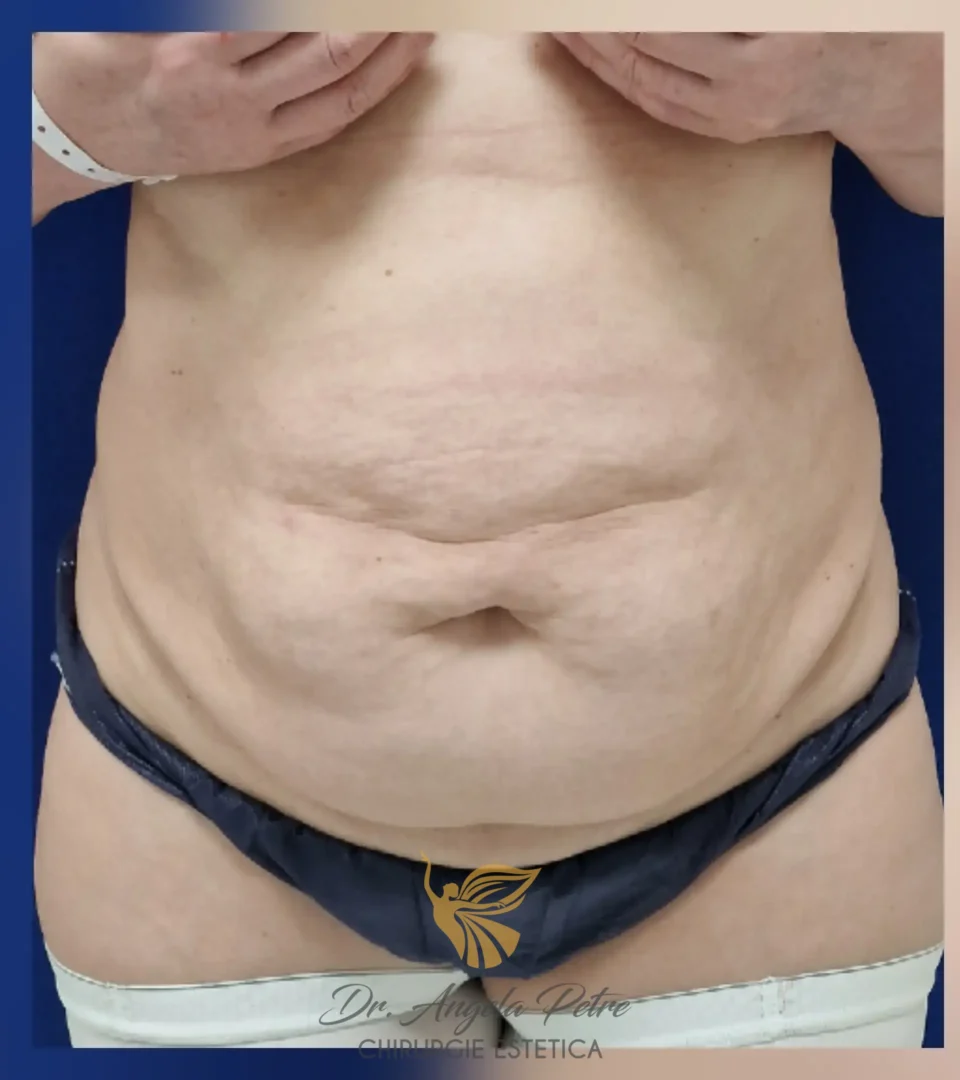 Caz 17 Abdominoplastie, frontal, before, Dr. Angela Petre - București