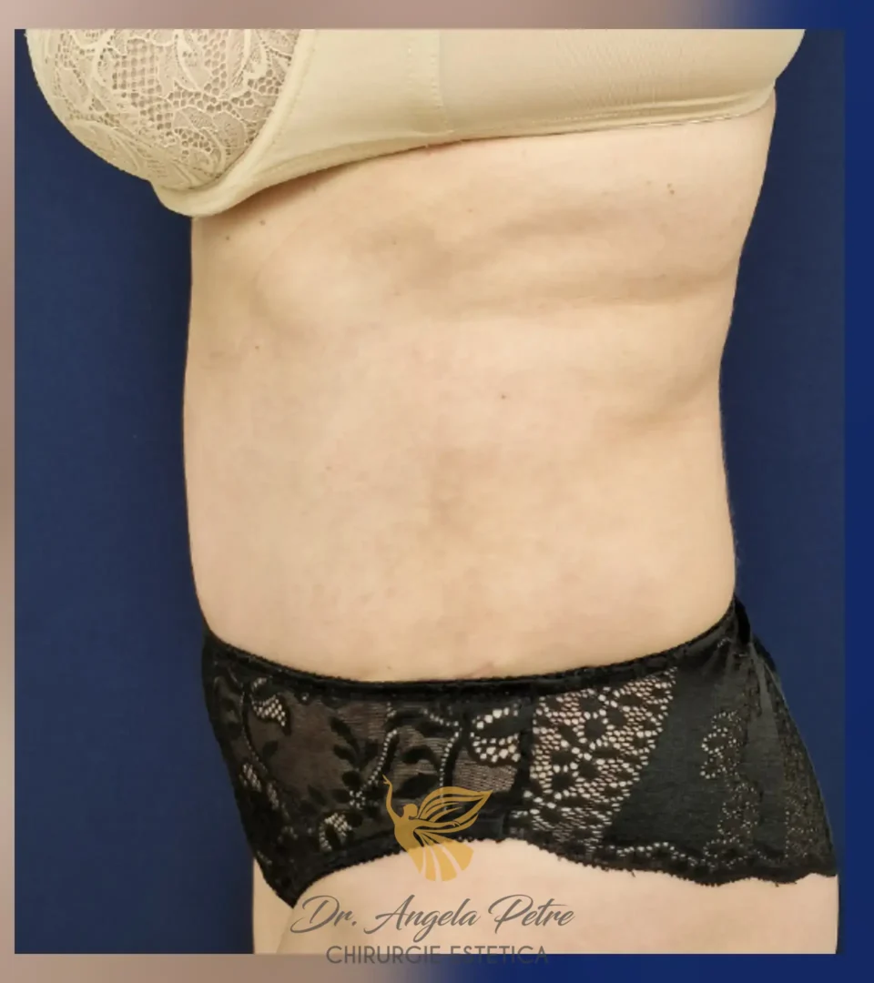 Caz 17 Abdominoplastie, profil, after, Dr. Angela Petre - București
