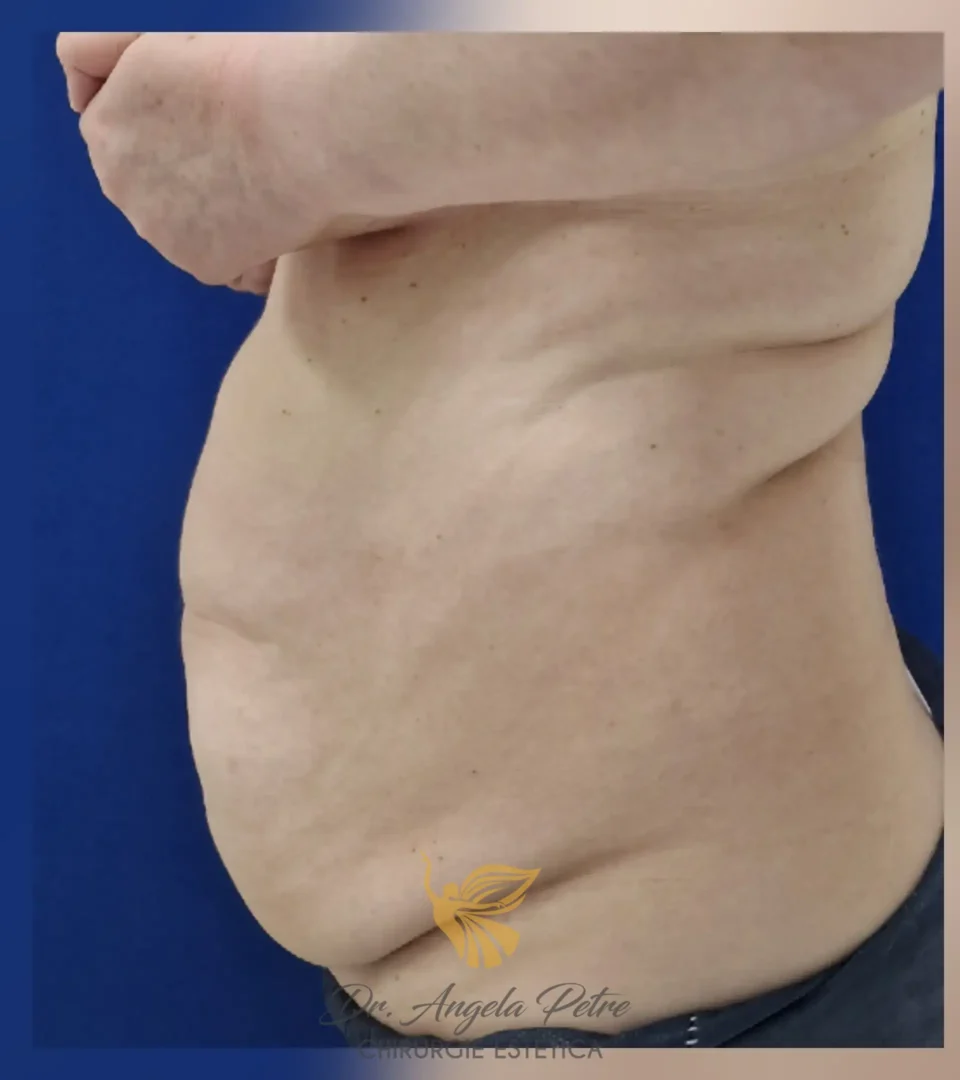 Caz 17 Abdominoplastie, profil, before, Dr. Angela Petre - București