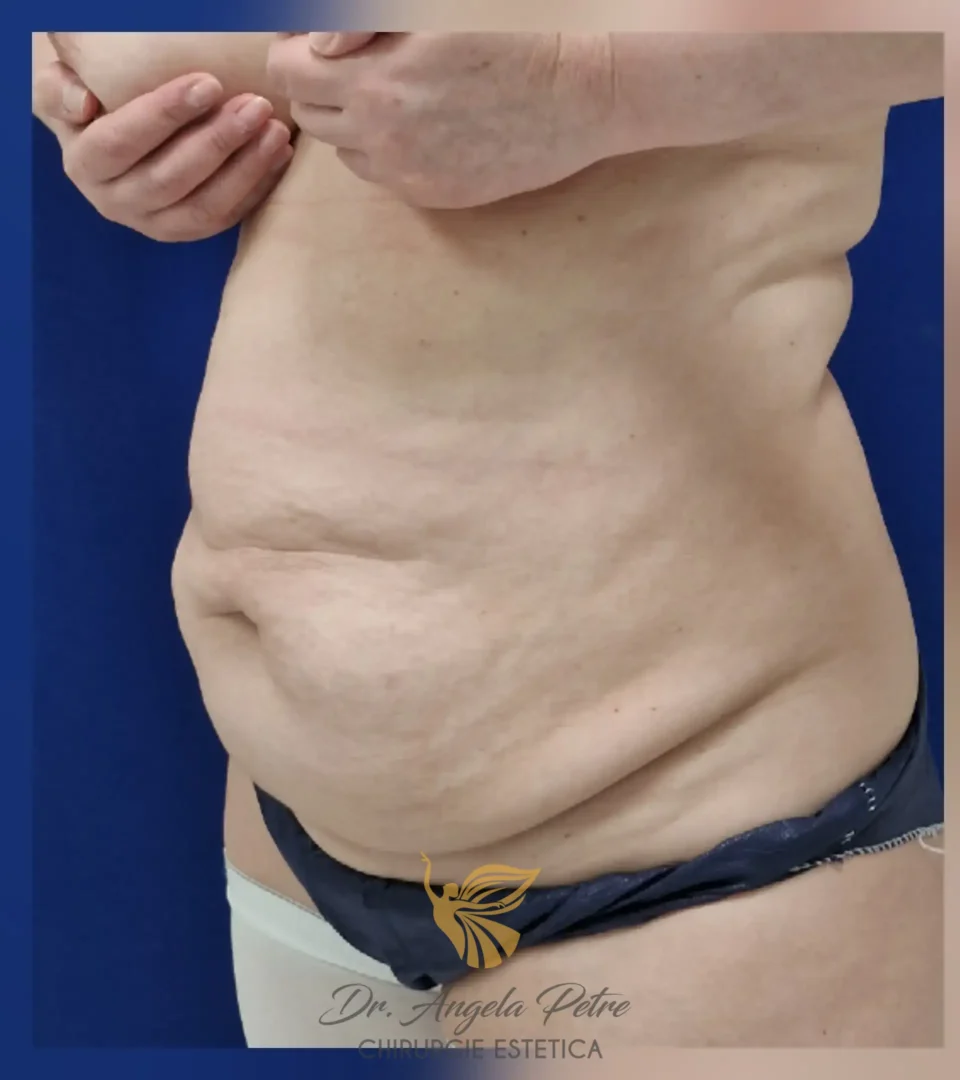 Caz 17 Abdominoplastie, semiprofil, before, Dr. Angela Petre - București
