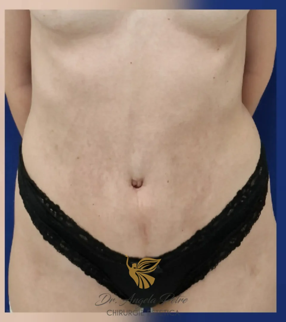 Caz 18 Abdominoplastie, frontal, after, Dr. Angela Petre - București
