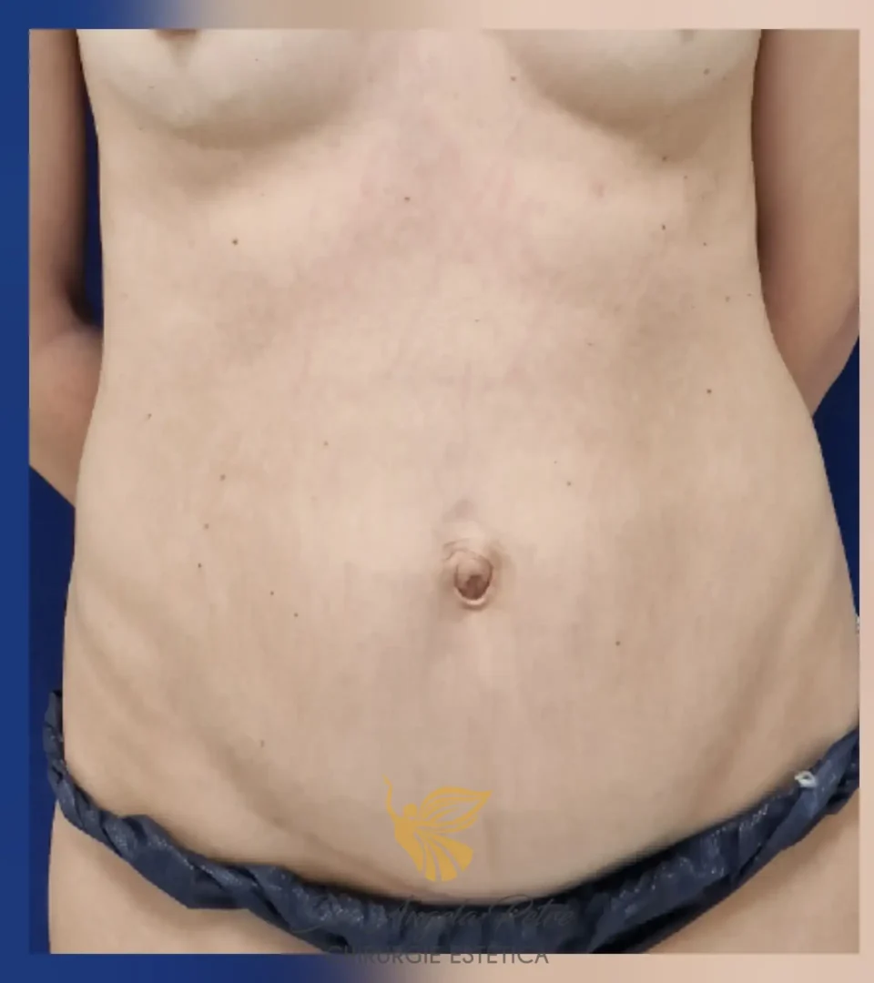 Caz 18 Abdominoplastie, frontal, before, Dr. Angela Petre - București