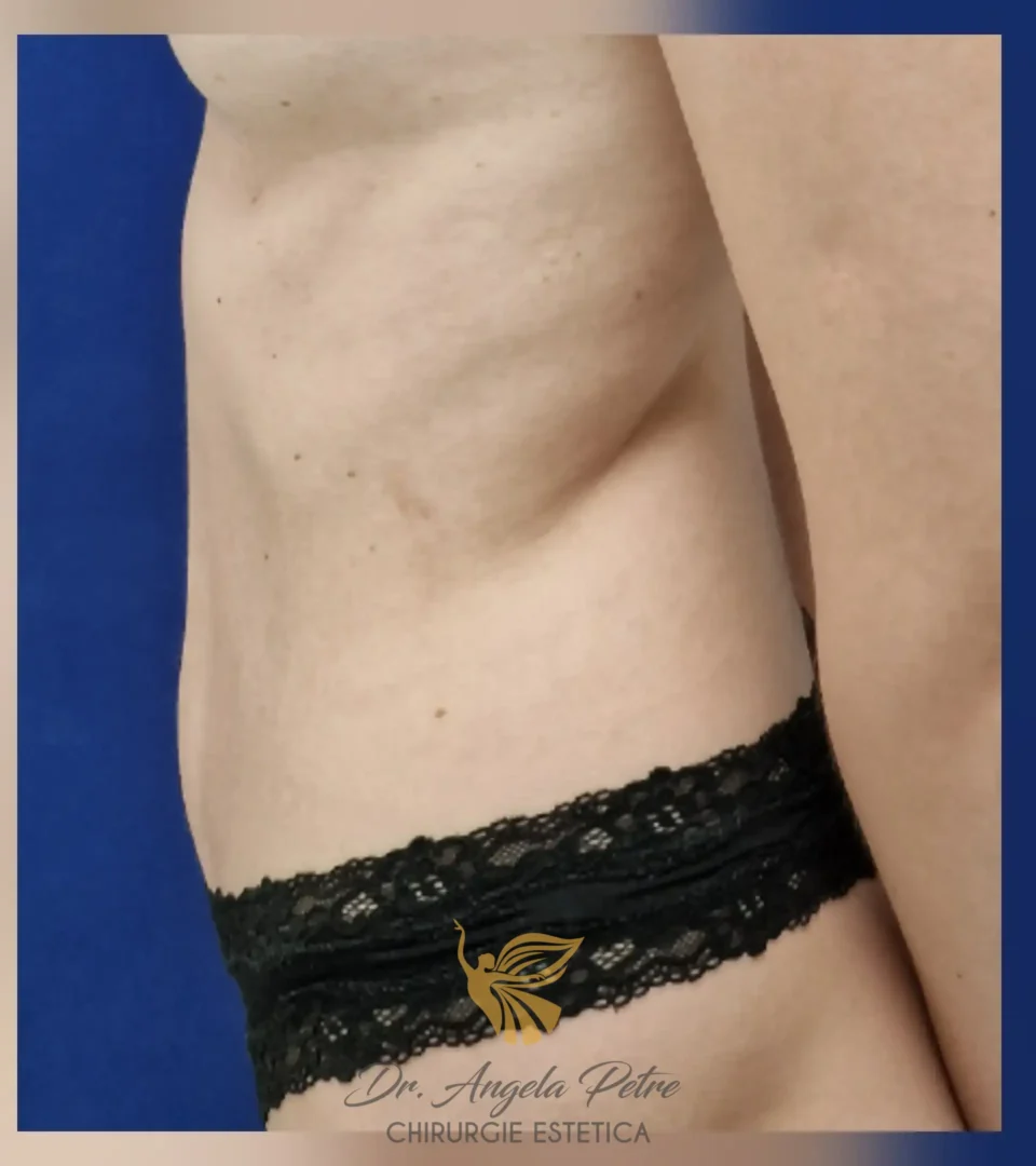 Caz 18 Abdominoplastie, profil, after, Dr. Angela Petre - București