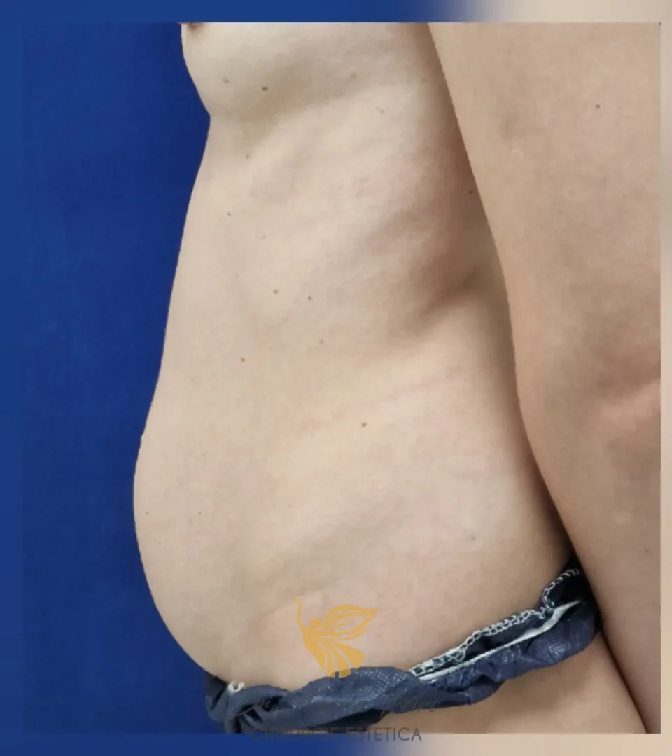 Caz 18 Abdominoplastie, profil, before, Dr. Angela Petre - București