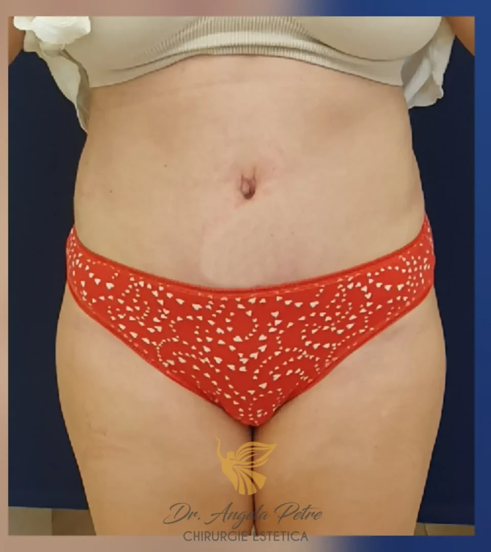 Caz 19 Abdominoplastie, frontal, after, Dr. Angela Petre - București