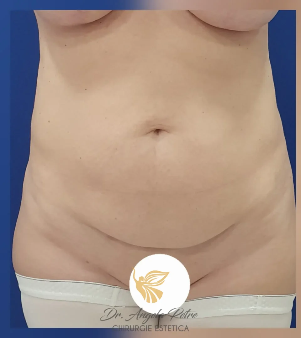 Caz 19 Abdominoplastie, frontal, before, Dr. Angela Petre - București