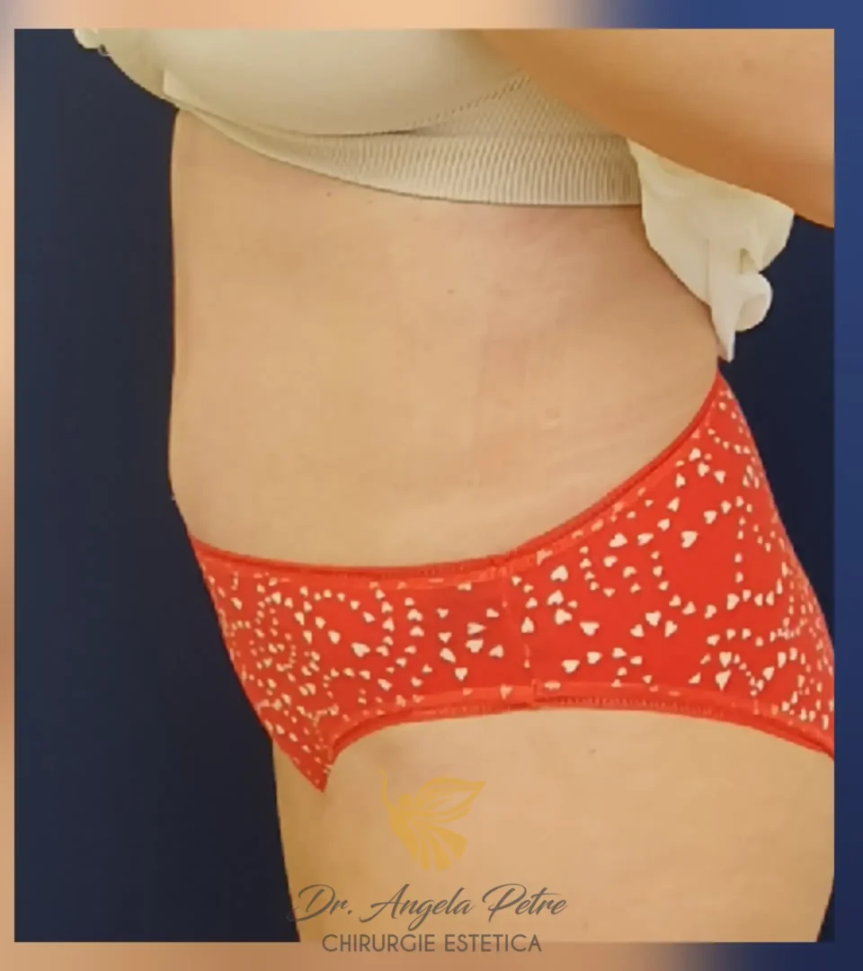 Caz 19 Abdominoplastie, profil, after, Dr. Angela Petre - București