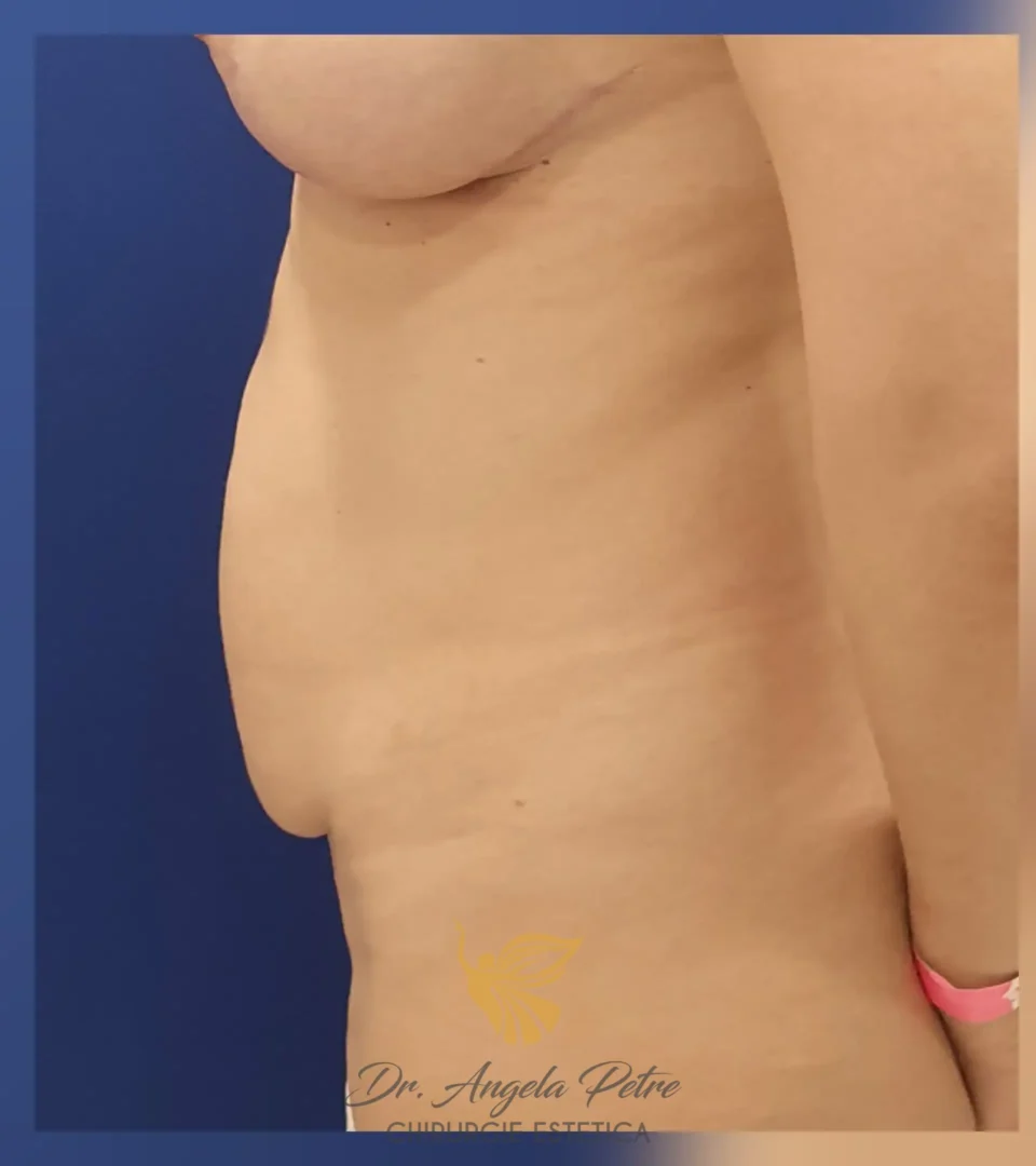 Caz 19 Abdominoplastie, profil, before, Dr. Angela Petre - București