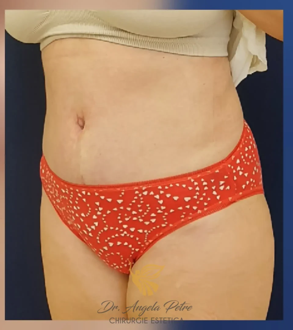 Caz 19 Abdominoplastie, semiprofil, after, Dr. Angela Petre - București