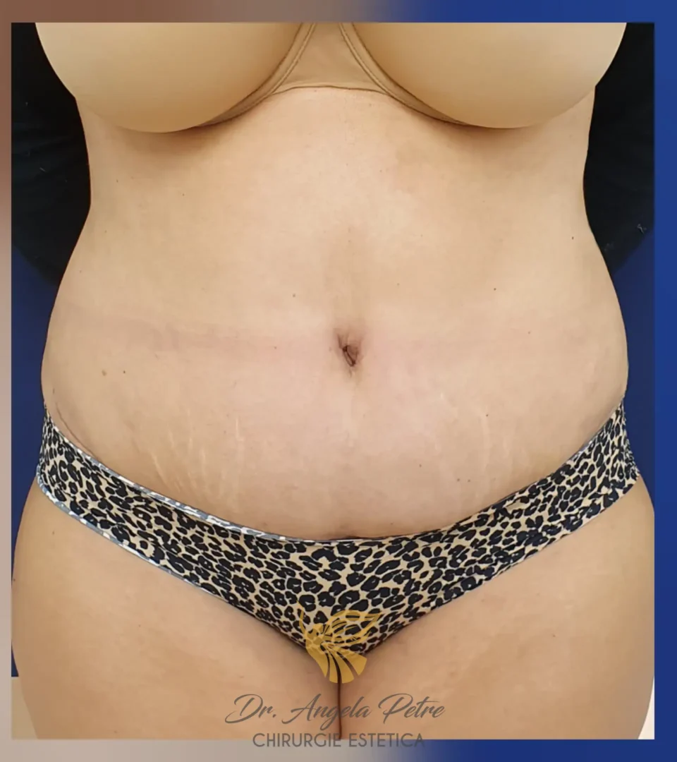 Caz 01 Abdominoplastie, frontal, after, Dr. Angela Petre - București