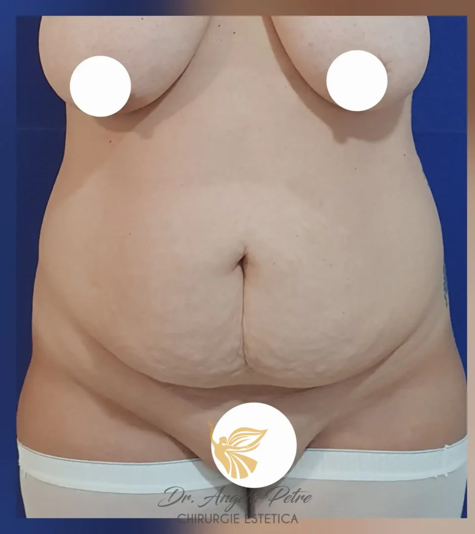 Caz 01 Abdominoplastie, frontal, before, Dr. Angela Petre - București