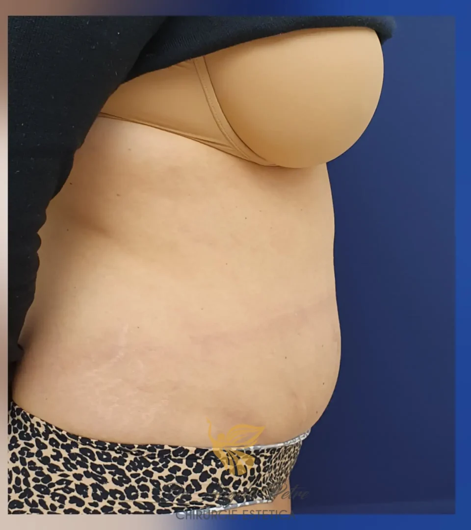 Caz 01 Abdominoplastie, profil, after, Dr. Angela Petre - București