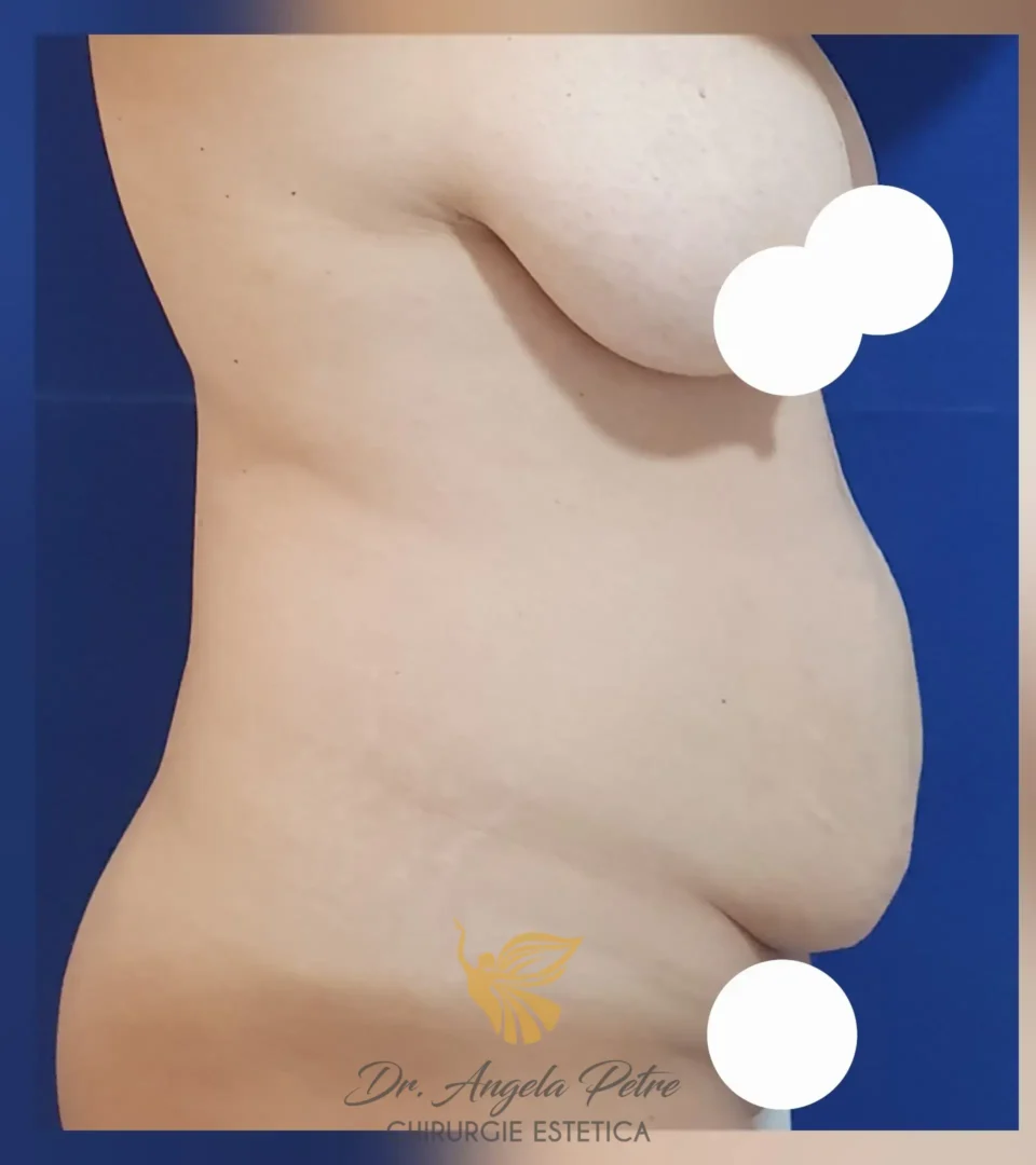 Caz 01 Abdominoplastie, profil, before, Dr. Angela Petre - București