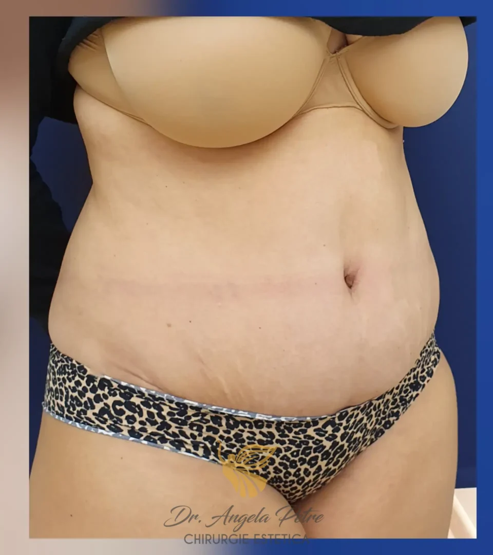 Caz 01 Abdominoplastie, semiprofil, after, Dr. Angela Petre - București